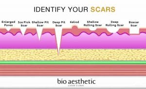 fractional co2 laser acne scars singapore bio aesthetic