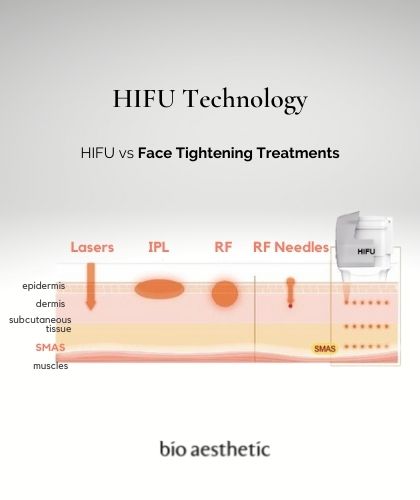 hifu treatment