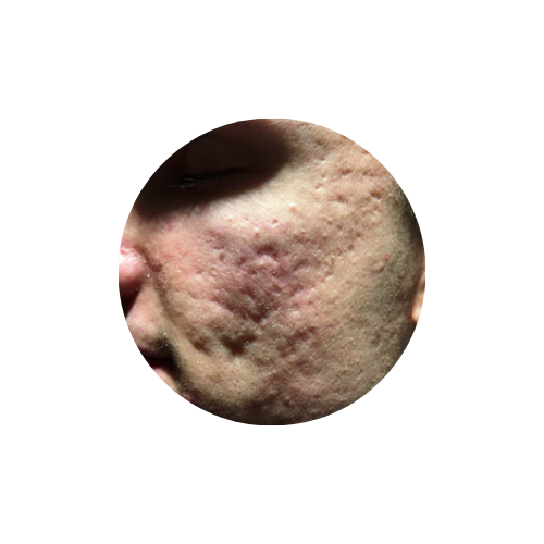 subcision rolling deep acne scars