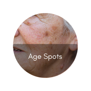age spots