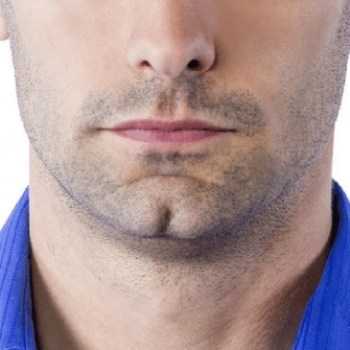 cleft chin filler