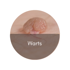 warts removal