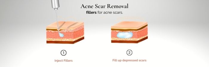 fillers for acne scars - acne scars treatment