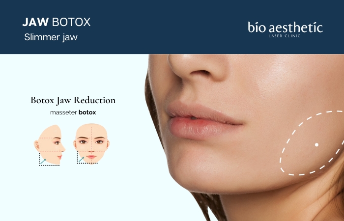 jaw botox reduction