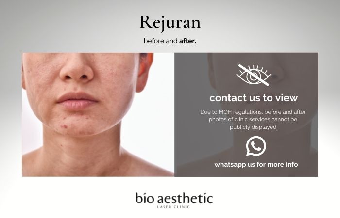 rejuran before and after