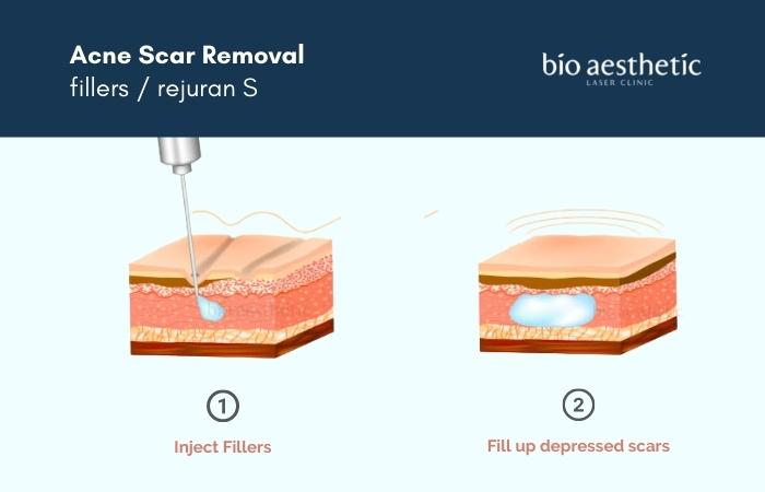 rejuran s acne scar removal