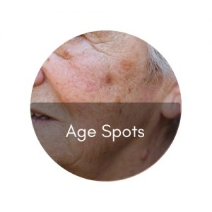 age spot
